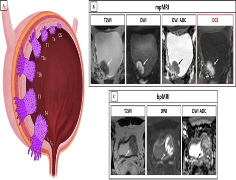 Schematic Representation Of The Bladder Cancer Stage And Case