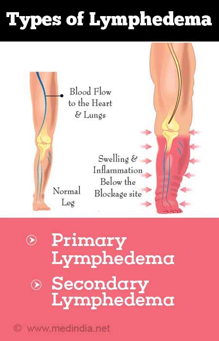 Genital Lymphedema Types Causes Symptoms Diagnosis 48 Off