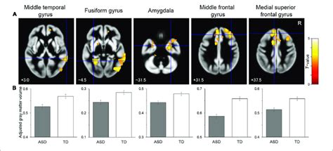 Brain Regions Showing Significantly Reduced Gray Matter Volume In The