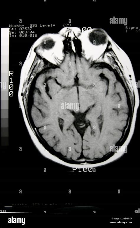 MRI scan of patient's brain with and without contrast agent Stock Photo ...