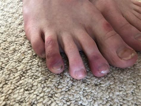 9 Photos Showing What Covid Fingers And Toes Can Look Like Huffpost