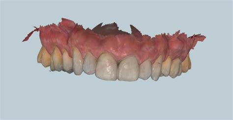 Innovaci N En Nuestra Cl Nica Dental El Esc Ner Intraoral Y Sus