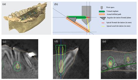 Applied Sciences Free Full Text 3d Printed Metal Surgical Guide For Endodontic Microsurgery