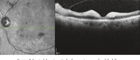 Figure From Optical Coherence Tomography Angiography Of Combined