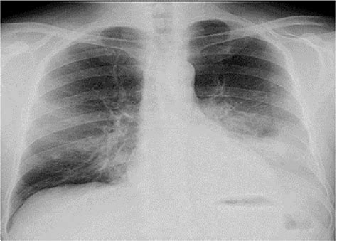 Initial chest radiograph revealed a left lower lobe consolidation... | Download Scientific Diagram