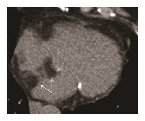 Lipomatous Hypertrophy Of The Interatrial Septum As Incidental Finding