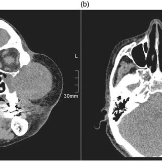 Preoperative Computed Tomography Scan Showing The Mass On The Left