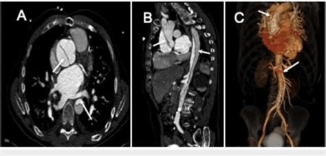 Type A Aortic Dissection A Axial Contrast Enhanced Ct Image