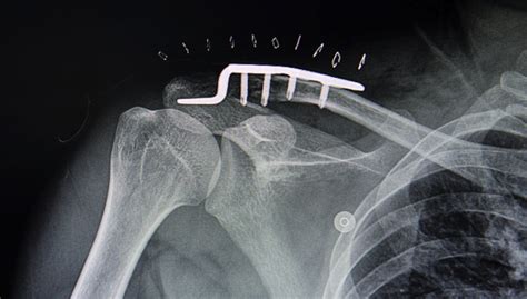 The essential guide to clavicle fracture