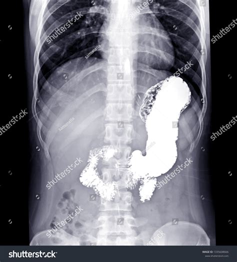 Gastrointestinal X Ray