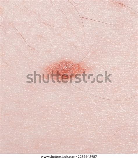 Nevus On Skin Melanoma Cancer Dermatology Stock Photo 2282443987 ...