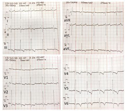 syncope pediatria integral