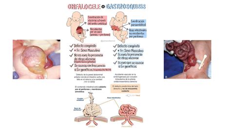 SpotlightMed Onfalocele Y Gastrosquisis SpotlightMed 56 OFF