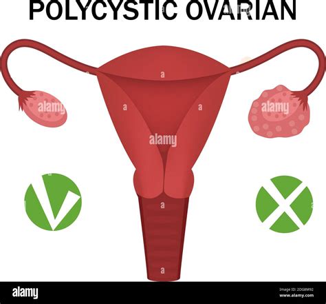 Polycystic Ovary Disease And A Healthy Ovary Medical Infographics