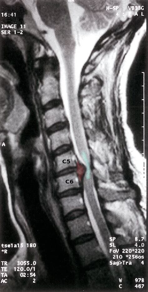 What Causes Early Degenerative Disc Disease At William Hays Blog