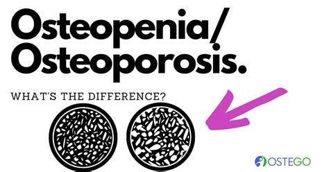 Osteopenia And Osteoporosis