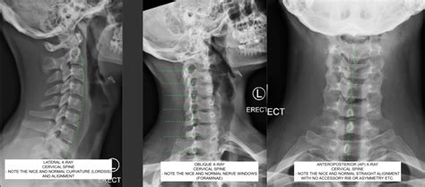 Oblique upper cervical spine x ray - modestat