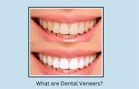 Composite Bonding Vs Veneers What You Didn T Know Oral Health Line