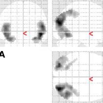 Maximal Intensity Projections MIP Of Clusters That Survived P