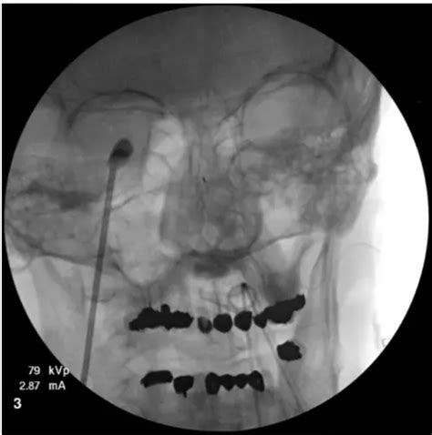 Percutaneous Balloon Trigeminal Rhizotomy For Trigeminal Neuralgia