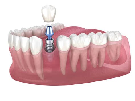 Your Treatment Options at Dental Implants Direct