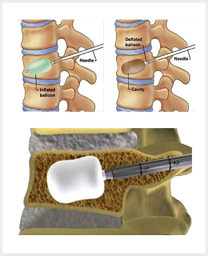 Kyphoplasty And Sacroplasty For Compression Fractures Back Pain Treatment