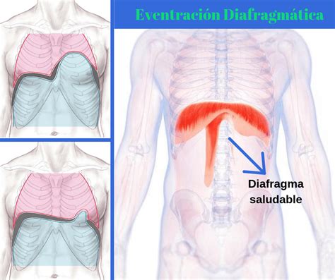 Eventración diafragmática