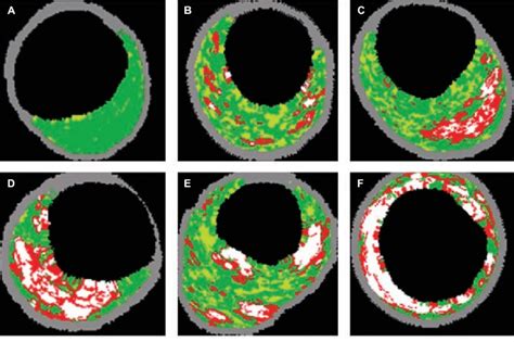 Classification Of Atheromatous Plaques With Ivus Vh A Adaptive