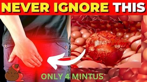 Critical Colon Cancer Symptoms You Should Never Ignore Everyday