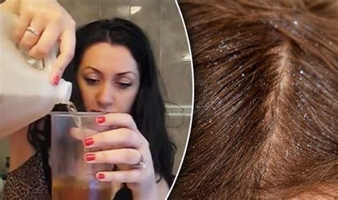 How To Get Rid Of Dandruff Use Apple Cider Vinegar To Banish A Dry