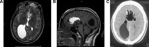 Intracranial Space Occupying Lesion In A Man With Mood Swings Journal