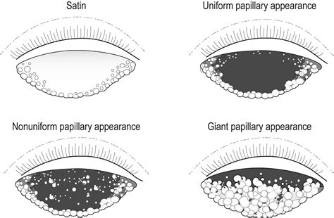 Giant Papillary Conjunctivitis Clinical Tree