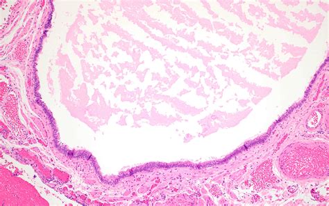 Synovial Cyst Histology