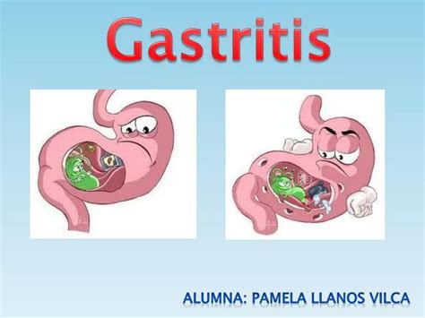 Ppt Gastritis Powerpoint Presentation Free Download Id 5474429