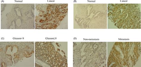 The Expression And Significance Of P4e‐bp14e‐bp1 In Prostate Cancer Wang 2022 Journal Of