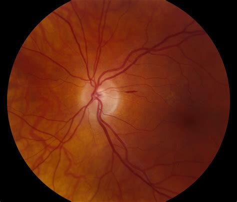 Whitman Images: Hemorrhage around the Optic Nerve