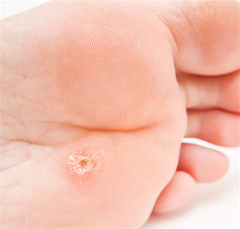 Homeopathic Treatment for Warts | Homeoeclinic