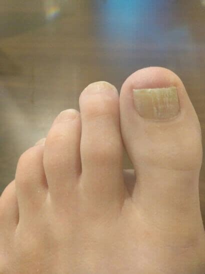 Laser Toenail Fungus Treatments | Lighttouch Laser Clinic