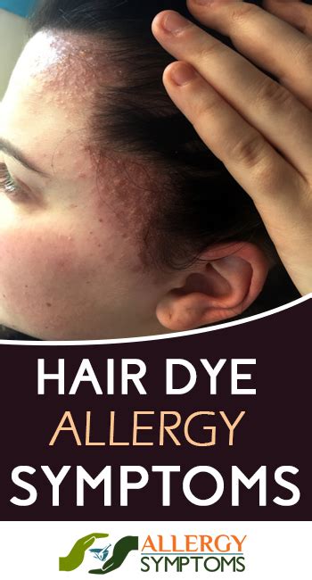 Hair Dye Allergy Symptoms Allergy Symptoms