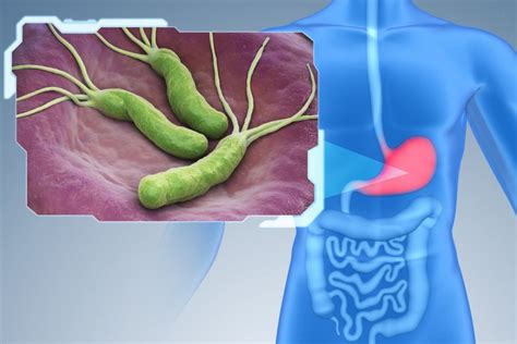 Helicobacter Pylori infection: Symptoms and complications - Dr Ganesh ...