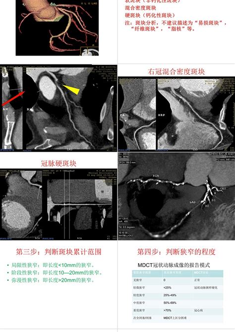 冠状动脉CTA报告规范ppt模板 卡卡办公