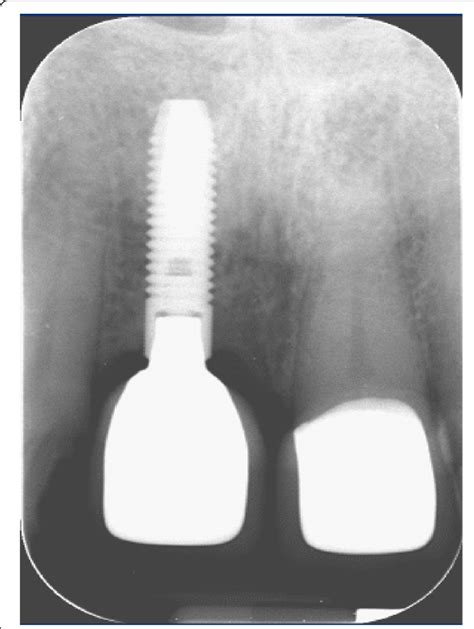 Single Tooth X Ray 1 Year Post Implantation Showing The Finalized