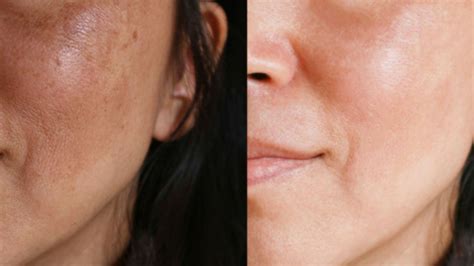 Microagulhamento Para Melasma Veja Como Funciona Priorize Clinic