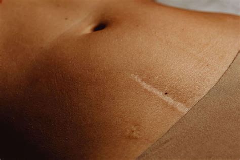 Chirurgie esthétique et cicatrisation tout ce que vous devez savoir