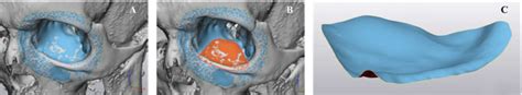 Virtual Surgical Planning Vsp For The Reconstruction Of The Orbital