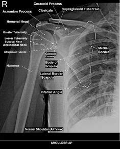 Right Shoulder X Ray