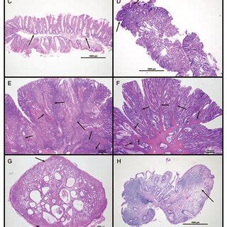 Histology of common gastrointestinal polyps. (A and B) Tubular adenoma;... | Download Scientific ...