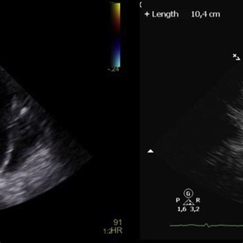 Transthoracic Echocardiography Suprasternal View Depicting The Large