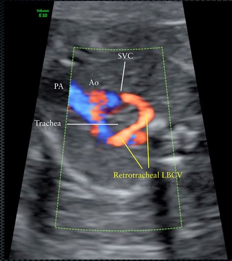 Intrathymic And Other Anomalous Courses Of The Left Brachiocephalic Vein In The Fetus Karl