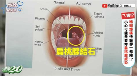 健康 Med 喉嚨痛快篩1條線「4hr竟進加護病房插管」 醫揭恐怖症狀：會死亡 生活 Ctwant Ctwant